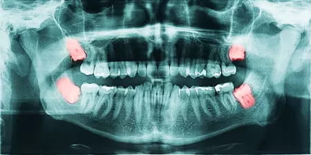Radiographie des dents de sagesse
